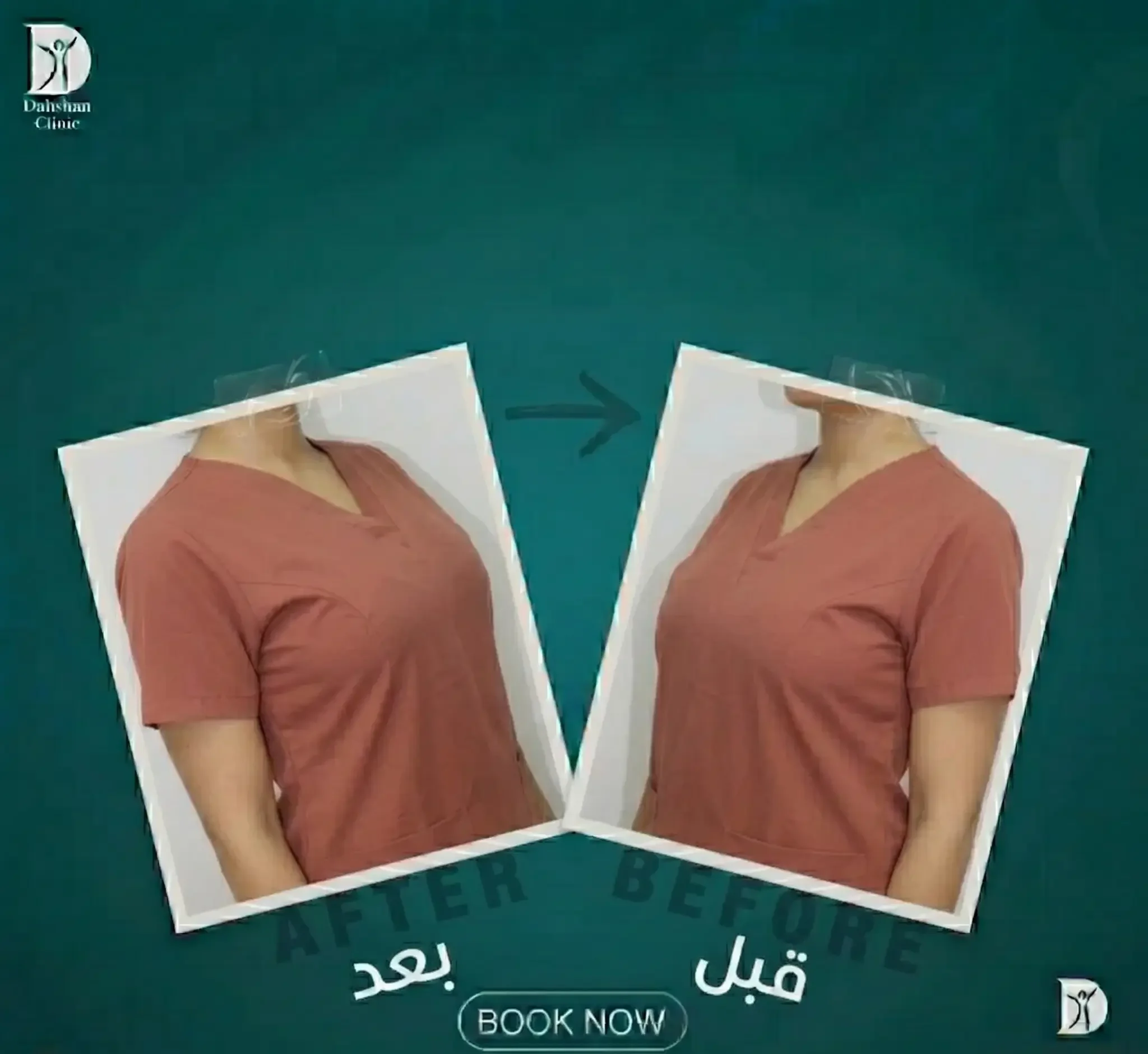 تصغير الثدي في دهشان كلينيك