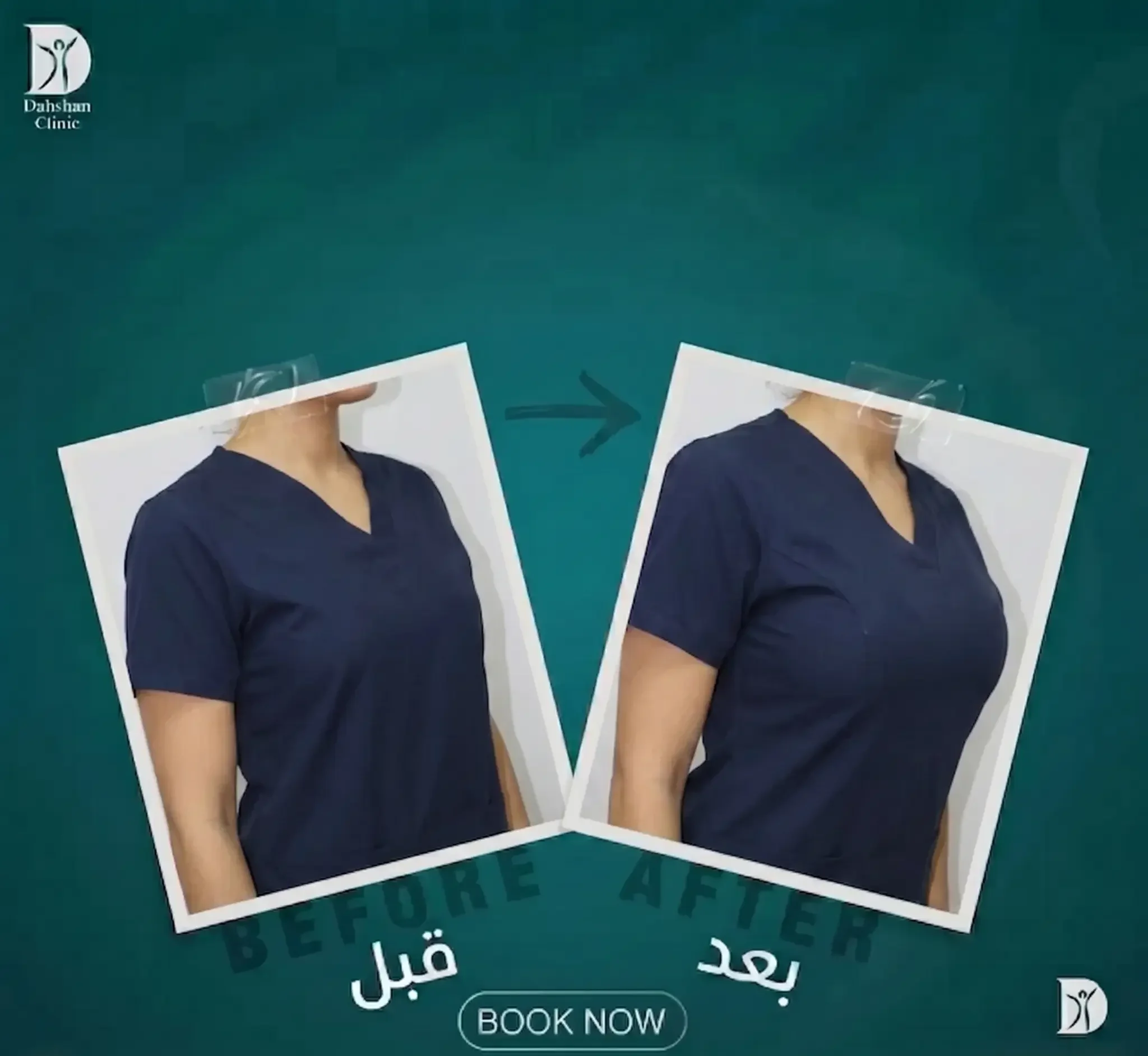 تكبير الثدي