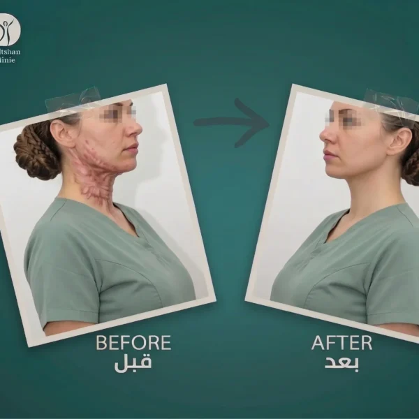 جراحة الحروق