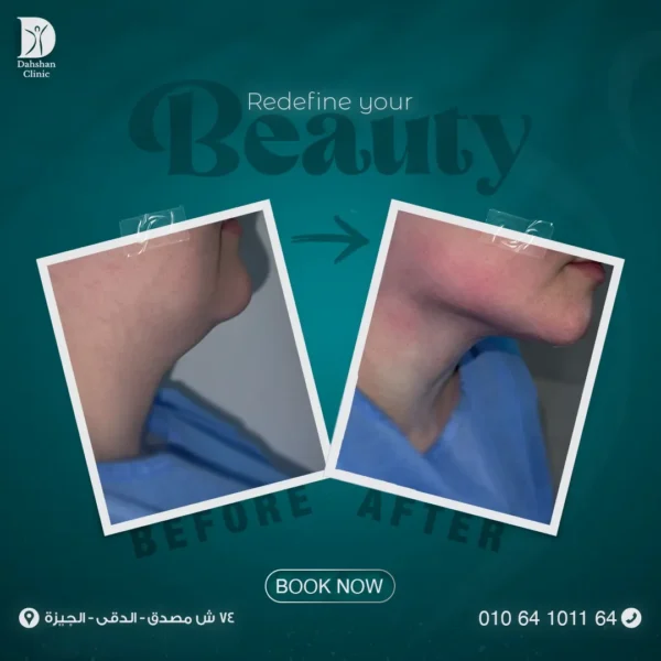 شد الوجه غير الجراحي
