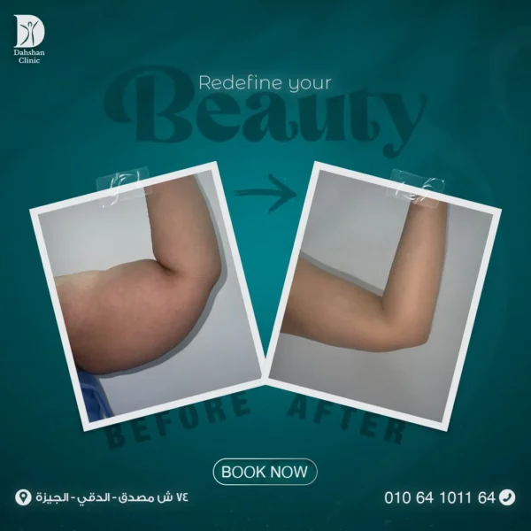 شفط الدهون